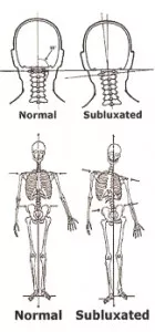 one leg shorter than the other and the atlas