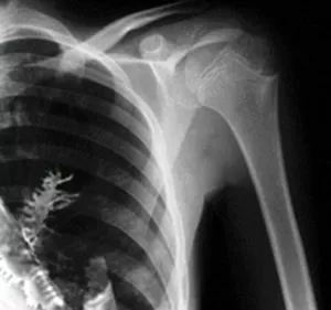 fir tree, like an energetic attachment, is growing inside man's lung