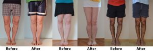 legs-before-after