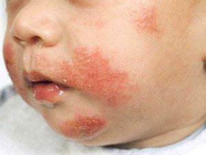 rash around the mouth from offending food
