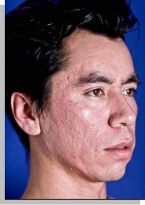 How_to_Repair_Acne_Scars-213x300